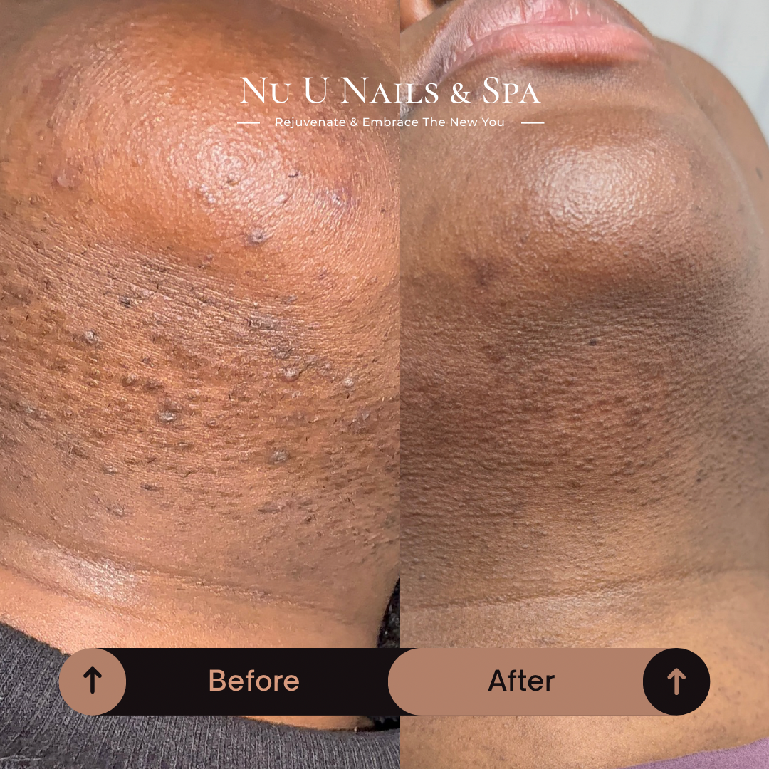 Before and after laser hair removal results